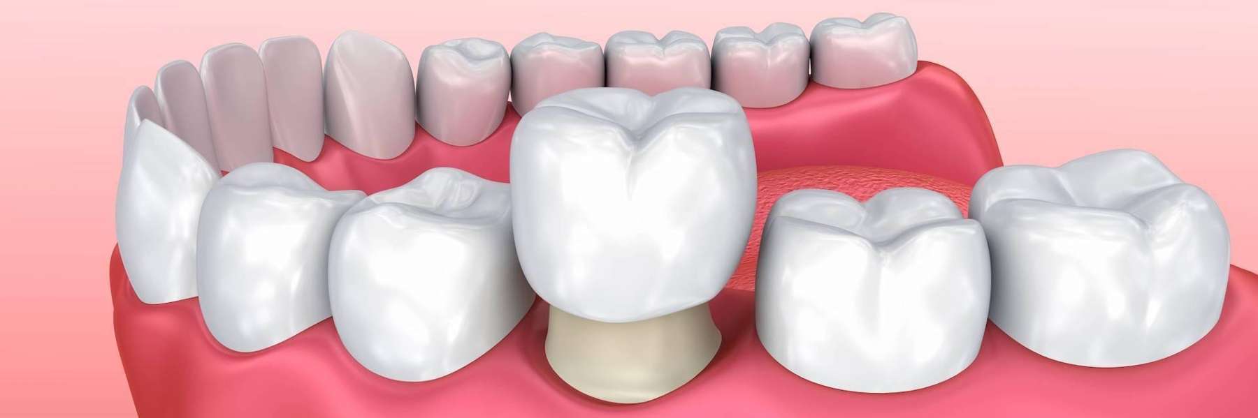 An illustration of a Dental crown in Decatur, IL