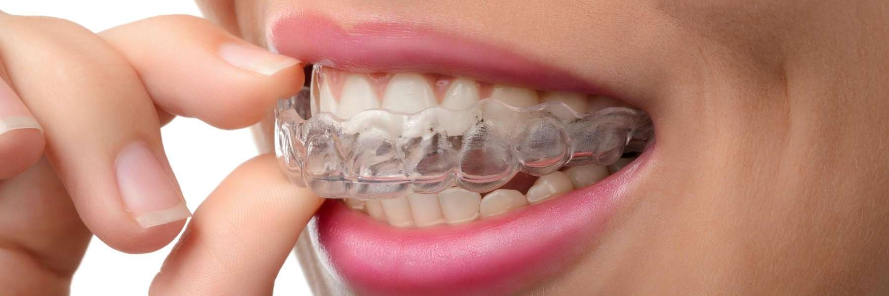 A close up of an Invisalign in Decatur, IL
