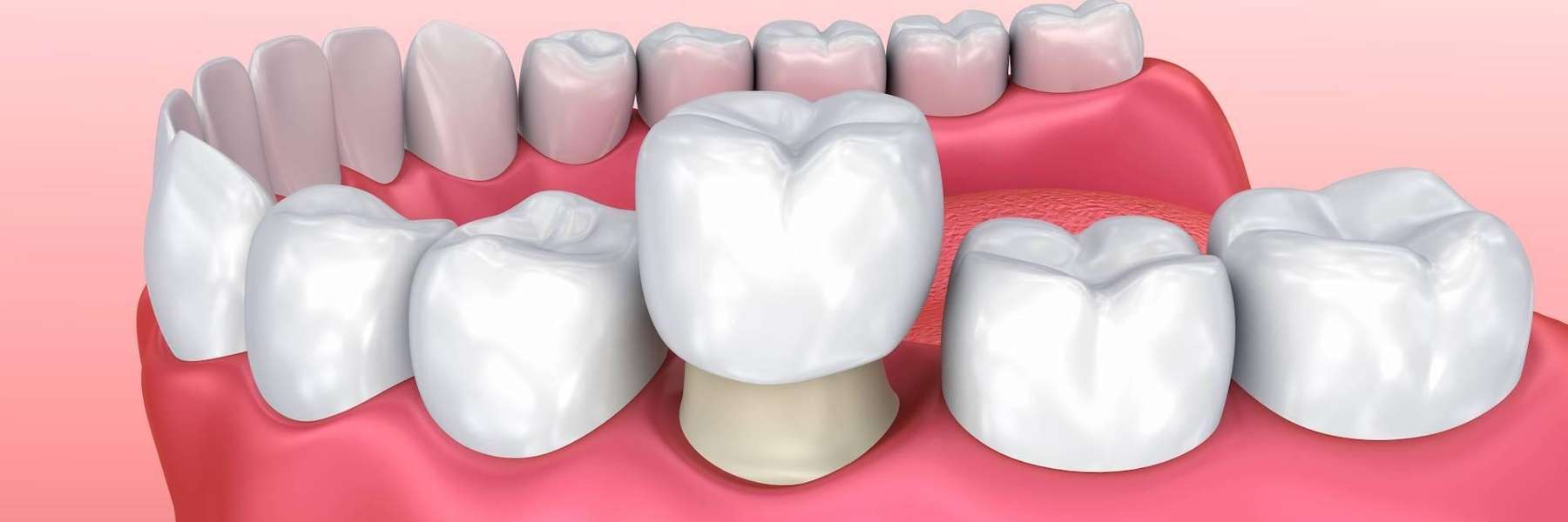 Dental Crown in Decatur, IL