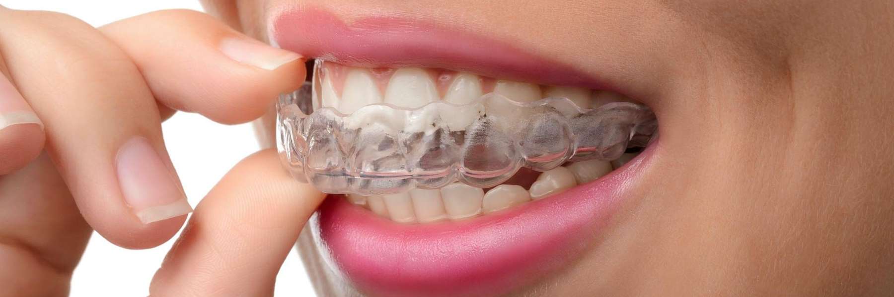 A woman wearing a clear aligner in Decatur, IL