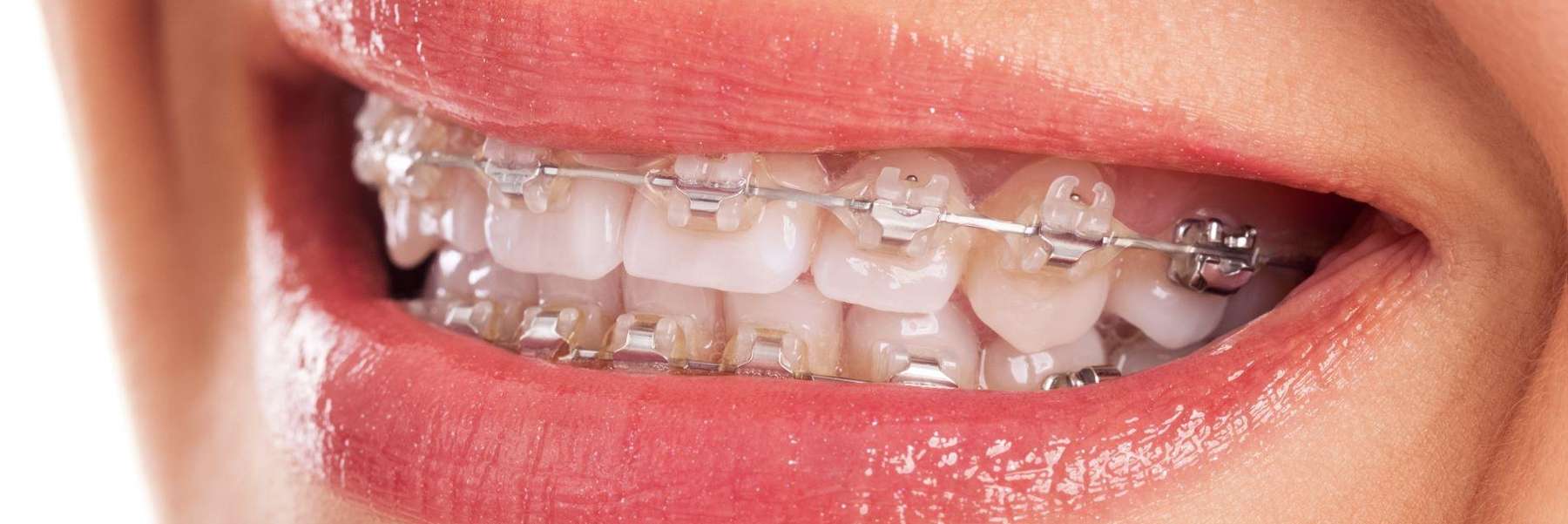 Patient's teeth with braces from Jerger Pediatric Dentistry