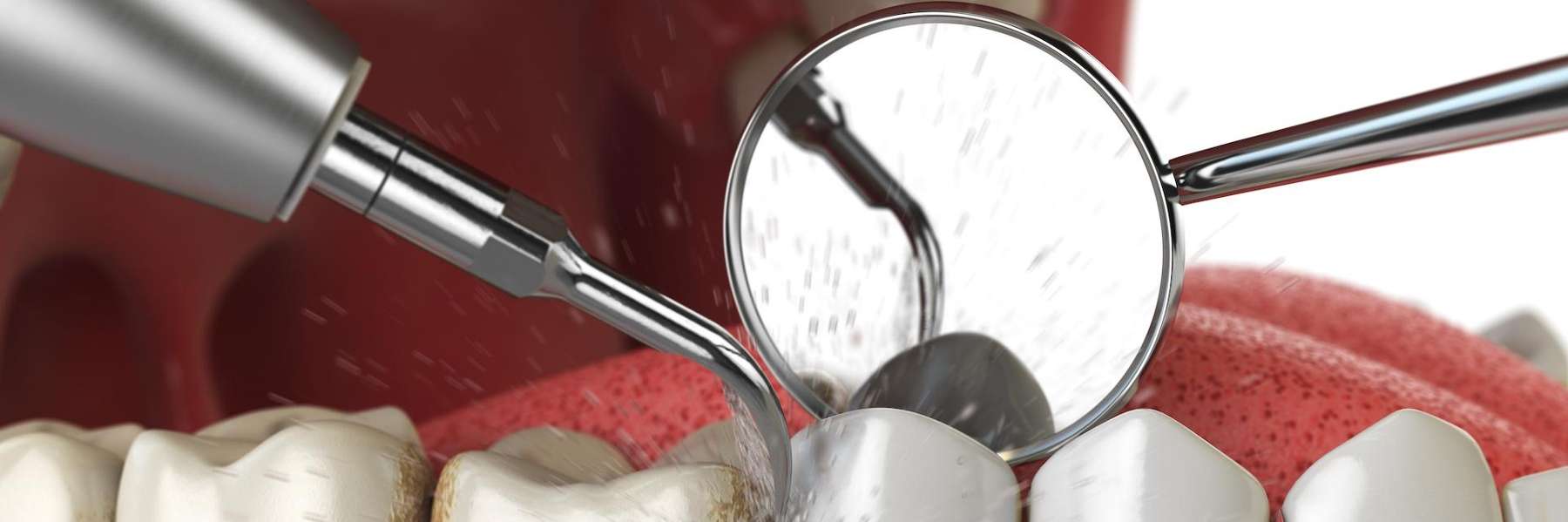 A picture depicting dental cleaning in Decatur, IL 