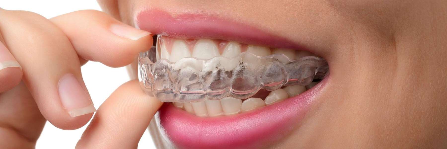 Children's Orthodontics in Decatur, IL
